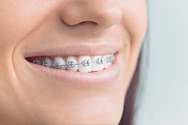 Dental Inlays and Onlays in Bradenton, FL